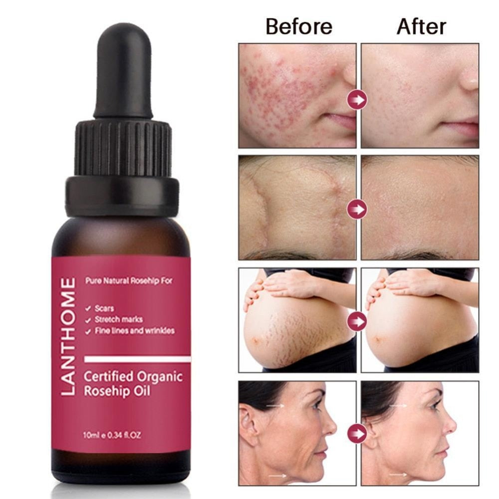 Pure Organic Rosehip Oil Antioxidantfor Scars Fine Lines Wrinkles Stretch Marks Improve Skin Elasticity Firmness - Virtual Blue Store