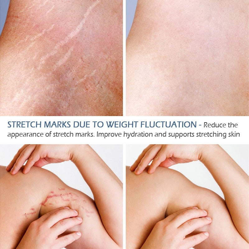Stretch Marks Remover Essential Oil Eliminate Pregnancy Scars Maternity Repair Anti Winkle Skin Firming Treatment - Virtual Blue Store