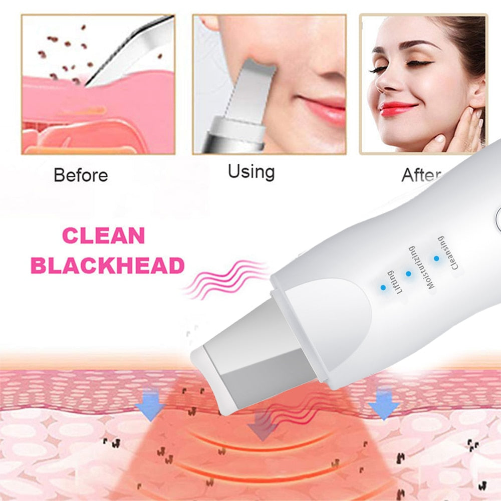 Ultrasonic Exfoliating Blackhead Remove Face Scrubber Vacuum Blemish Pimple Remover Pore Cleaning Tools Face Peeling Machine - Virtual Blue Store