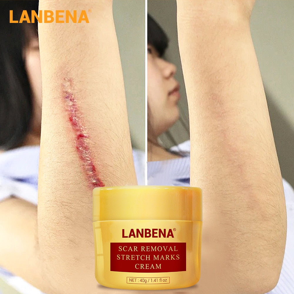 LANBENA Acne Scar Removal Cream Acne Spots Repair Acne Treatment Blackhead Whitening Stretch Marks Skin Care Bleaching Cream - Virtual Blue Store