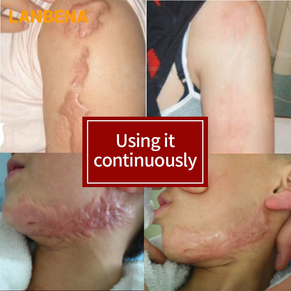 LANBENA Acne Scar Removal Cream Acne Spots Repair Acne Treatment Blackhead Whitening Stretch Marks Skin Care Bleaching Cream - Virtual Blue Store