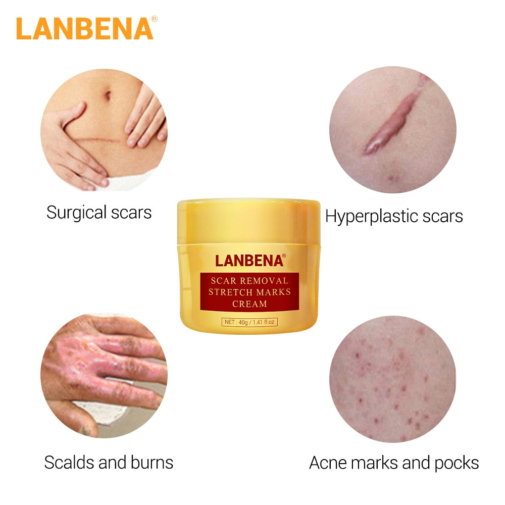 LANBENA Acne Scar Removal Cream Acne Spots Repair Acne Treatment Blackhead Whitening Stretch Marks Skin Care Bleaching Cream - Virtual Blue Store