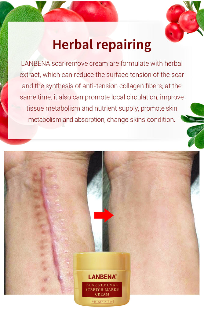 LANBENA Acne Scar Removal Cream Acne Spots Repair Acne Treatment Blackhead Whitening Stretch Marks Skin Care Bleaching Cream - Virtual Blue Store