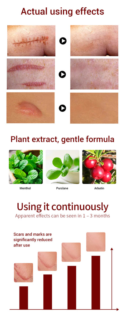LANBENA Acne Scar Removal Cream Acne Spots Repair Acne Treatment Blackhead Whitening Stretch Marks Skin Care Bleaching Cream - Virtual Blue Store