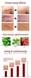 LANBENA Acne Scar Removal Cream Acne Spots Repair Acne Treatment Blackhead Whitening Stretch Marks Skin Care Bleaching Cream - Virtual Blue Store