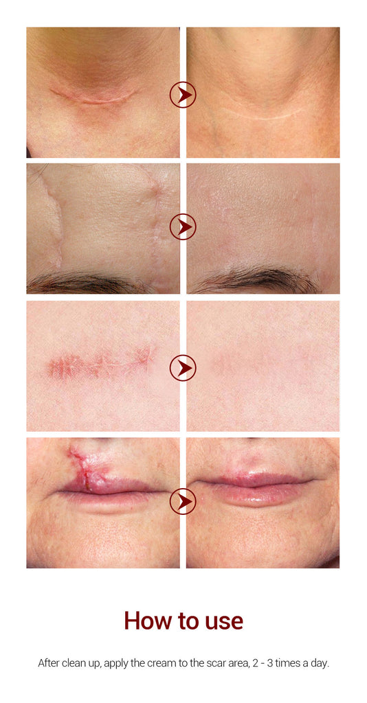 LANBENA Acne Scar Removal Cream Acne Spots Repair Acne Treatment Blackhead Whitening Stretch Marks Skin Care Bleaching Cream - Virtual Blue Store