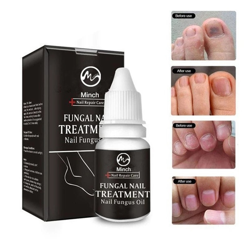 Minch Fungal Nail Treatment Serum Onychomycosis Paronychia Anti-Fungal Nail Infection Herbal Toe Fungus Foot Repair Essence Care