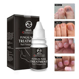 Minch Fungal Nail Treatment Serum Onychomycosis Paronychia Anti-Fungal Nail Infection Herbal Toe Fungus Foot Repair Essence Care