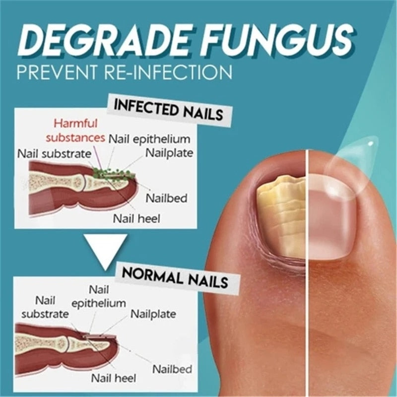 Minch Fungal Nail Treatment Serum Onychomycosis Paronychia Anti-Fungal Nail Infection Herbal Toe Fungus Foot Repair Essence Care