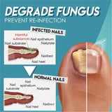 Minch Fungal Nail Treatment Serum Onychomycosis Paronychia Anti-Fungal Nail Infection Herbal Toe Fungus Foot Repair Essence Care
