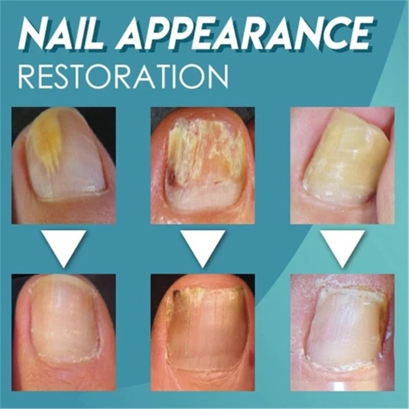 Minch Fungal Nail Treatment Serum Onychomycosis Paronychia Anti-Fungal Nail Infection Herbal Toe Fungus Foot Repair Essence Care