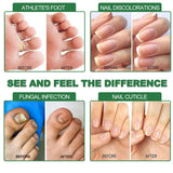 7 Days Nail Fungus Treatment Serum Ginger Anti-infective Paronychia Onychomycosis Toe Foot Nail Fungal Repair Gel Hand Foot Care