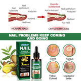 7 Days Nail Fungus Treatment Serum Ginger Anti-infective Paronychia Onychomycosis Toe Foot Nail Fungal Repair Gel Hand Foot Care