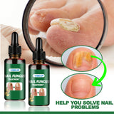 7 Days Fungal Nail Treatment Serum Foot Nail Fungus Removal Repair Gel Anti Infection Paronychia Onychomycosis Foot Nails Care