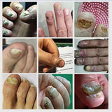 7 Days Nail Fungus Treatment Serum Ginger Anti-infective Paronychia Onychomycosis Toe Foot Nail Fungal Repair Gel Hand Foot Care