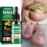 7 Days Fungal Nail Treatment Serum Foot Nail Fungus Removal Repair Gel Anti Infection Paronychia Onychomycosis Foot Nails Care