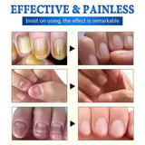 7 Days Nail Fungus Treatment Serum Ginger Anti-infective Paronychia Onychomycosis Toe Foot Nail Fungal Repair Gel Hand Foot Care