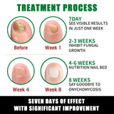 7 Days Fungal Nail Treatment Serum Foot Nail Fungus Removal Repair Gel Anti Infection Paronychia Onychomycosis Foot Nails Care