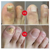 7 Days Fungal Nail Treatment Serum Foot Nail Fungus Removal Repair Gel Anti Infection Paronychia Onychomycosis Foot Nails Care