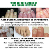 7 Days Fungal Nail Treatment Serum Foot Nail Fungus Removal Repair Gel Anti Infection Paronychia Onychomycosis Foot Nails Care