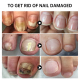 7 Days Fungal Nail Treatment Serum Foot Nail Fungus Removal Repair Gel Anti Infection Paronychia Onychomycosis Foot Nails Care