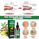 7 Days Fungal Nail Treatment Serum Foot Nail Fungus Removal Repair Gel Anti Infection Paronychia Onychomycosis Foot Nails Care