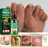 7 Days Nail Fungus Treatment Serum Ginger Anti-infective Paronychia Onychomycosis Toe Foot Nail Fungal Repair Gel Hand Foot Care