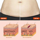 Stretch Marks Permanent Removal Oil Maternity Pregnant Women Pregnancy Anti-Winkle Smooth Repair Firming Skin Body Skin Care Cre