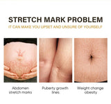 100ml Stretch Mark Removal Oil Removes Postpartum Pregnant Women Scar Repair Obesity Stretch Mark Anti-Aging Firming Serum Cream