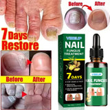 7 Days Fungal Nail Treatment Serum Foot Nail Fungus Removal Repair Gel Anti Infection Paronychia Onychomycosis Foot Nails Care