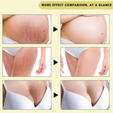 100ml Stretch Mark Removal Oil Removes Postpartum Pregnant Women Scar Repair Obesity Stretch Mark Anti-Aging Firming Serum Cream