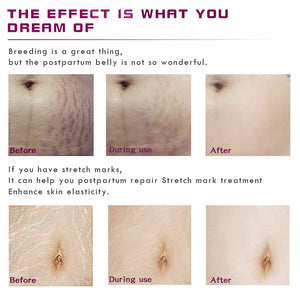 Stretch Marks Remover Essential Oil Eliminate Pregnancy Scars Maternity Repair Anti Winkle Skin Firming Treatment - Virtual Blue Store