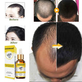 Hair Loss Products Natural With No Side Effects Grow Hair Faster Regrowth Hair Growth Products - Virtual Blue Store