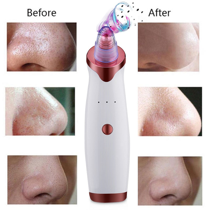 Ultrasonic Exfoliating Blackhead Remove Face Scrubber Vacuum Blemish Pimple Remover Pore Cleaning Tools Face Peeling Machine - Virtual Blue Store