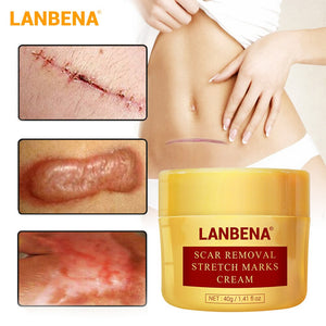 LANBENA Acne Scar Removal Cream Acne Spots Repair Acne Treatment Blackhead Whitening Stretch Marks Skin Care Bleaching Cream - Virtual Blue Store