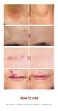 LANBENA Acne Scar Removal Cream Acne Spots Repair Acne Treatment Blackhead Whitening Stretch Marks Skin Care Bleaching Cream - Virtual Blue Store