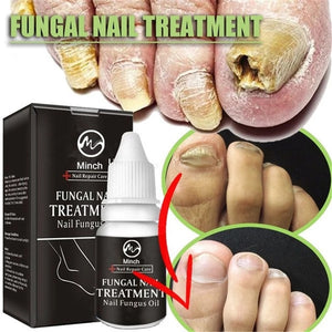 Minch Fungal Nail Treatment Serum Onychomycosis Paronychia Anti-Fungal Nail Infection Herbal Toe Fungus Foot Repair Essence Care