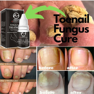 Minch Fungal Nail Treatment Serum Onychomycosis Paronychia Anti-Fungal Nail Infection Herbal Toe Fungus Foot Repair Essence Care