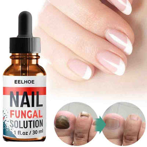 Nail Repair Serum Nail Fungal Treatment Serum Onychomycosis Paronychia Anti-Fungal Nail Infection  Toe Fungus Foot Repair  Care